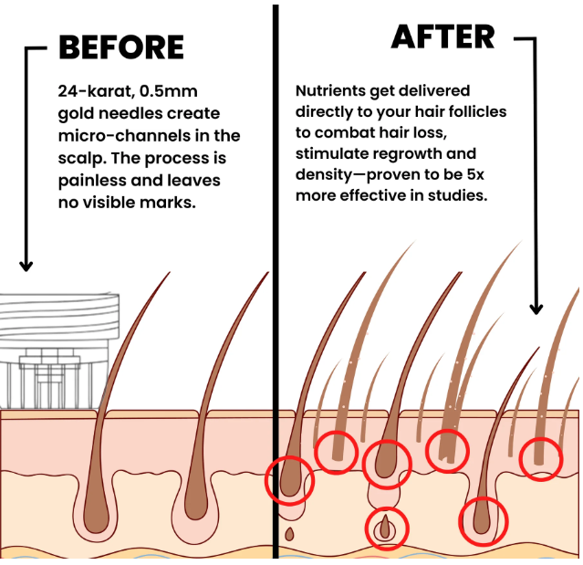 Zuvora™ Micro-Infusion Hair System