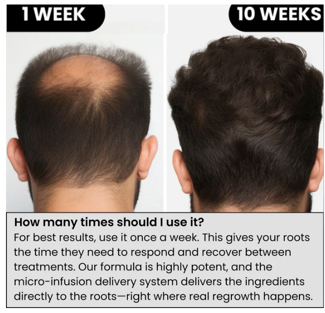 Zuvora™ Micro-Infusion Hair System