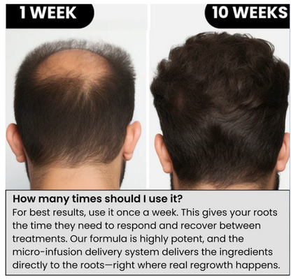Zuvora™ Micro-Infusion Hair System