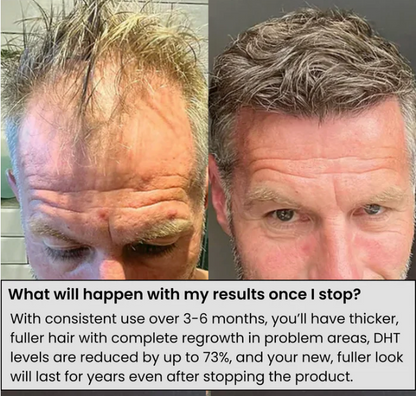 Zuvora™ Micro-Infusion Hair System